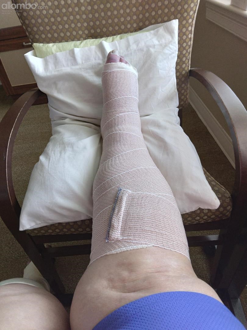 Fell and Broke my Ankle in 2 places. 1 on each side. Just a splint so far h...