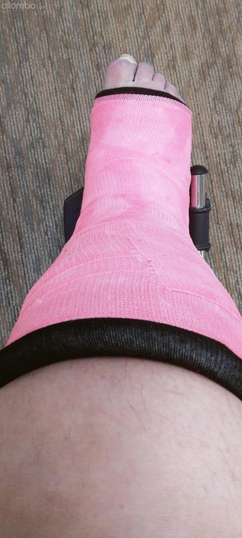 Pretty in PINK. Now in a cast for 6 weeks.