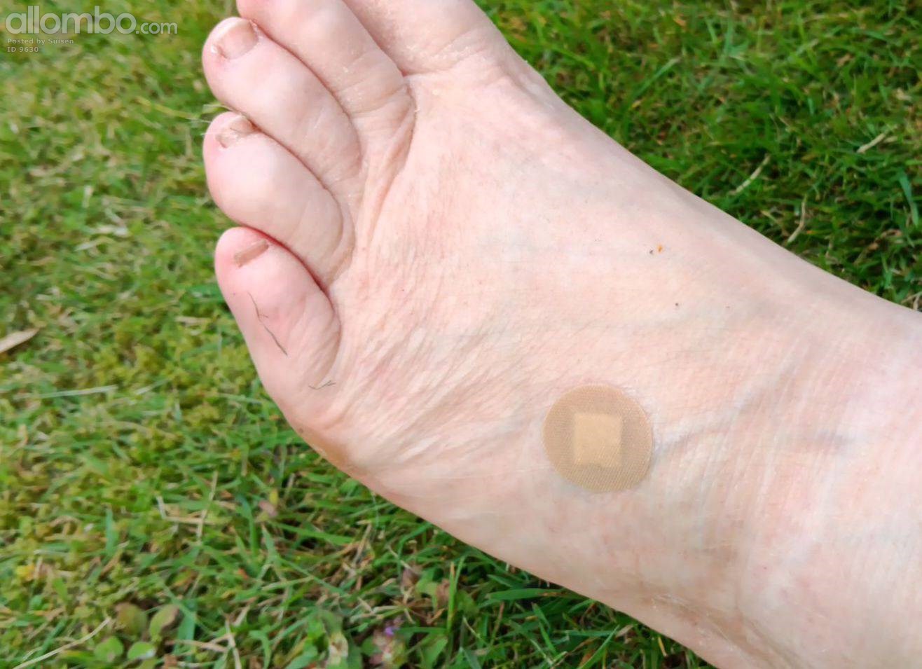 i use 2-3 layers of nailpolish and a waterproof plaster to get rid of warts...